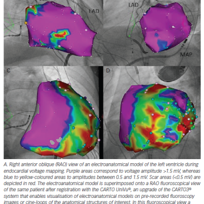 Pace Mapping of a Ventricular Premature Beat Utilising the PaSo® Module of CARTO® System