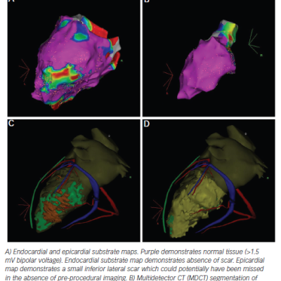 Figure 3 Pre-procedural Imaging in a Patient with Previous Myocarditis Presenting with Ventricular Tachycarida