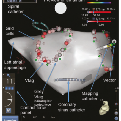 Figure 3 Three-dimensional Electroanatomical Map Bipolar Voltage Map Demonstrating Pulmonary Vein Isolation Procedure