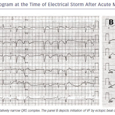 Figure 3 Twelve-lead Electrocardiogram at the Time of Electrical Storm After Acute Myocardial Infarction