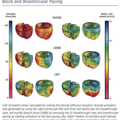 Figure 4 Results from a Biventricular FEM Based on the LV FEM32 During Normal Sinus Rhythm Left Bundle Branch Block and Biventricular Pacing