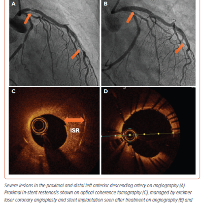 Figure 5 Imaging Findings Before and After Excimer Laser Coronary Angioplasty