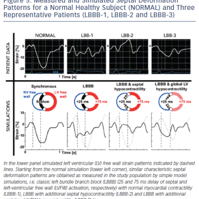 Figure 5 Measured and Simulated Septal Deformation Patterns for a Normal Healthy Subject NORMAL and Three Representative Patients LBBB-1 LBBB-2 and LBBB-3