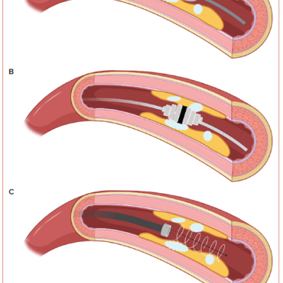 Figure 6 Atherectomy Devices for Calcium Modification