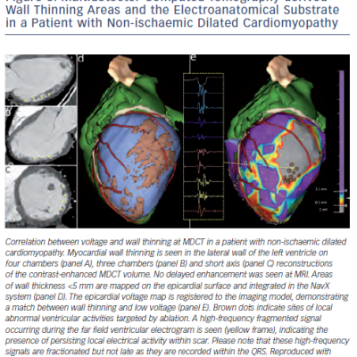 Figure 6 Multidetector Computed Tomography-derived Wall Thinning Areas and the Electroanatomical Substrate in a Patient with Non-ischaemic Dilated Cardiomyopathy