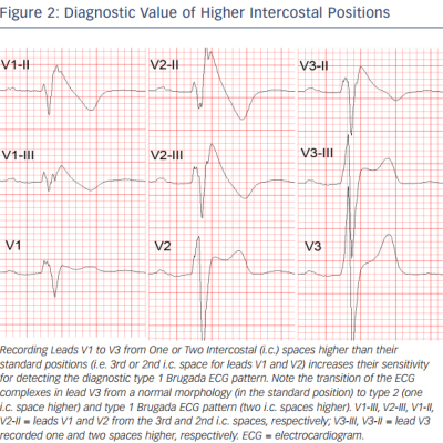 Figure 2 Diagnostic Value of Higher Intercostal Positions