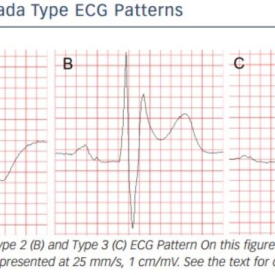 Figure 1 Brugada Type ECG Patterns