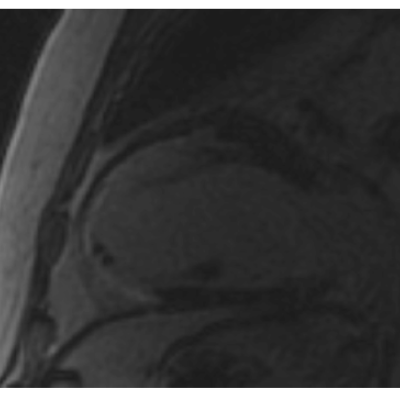 Figure 1 Anterior Myocardial Scar Due to Myocardial Infarction in a Patient with Systemic Lupus Erythematosus