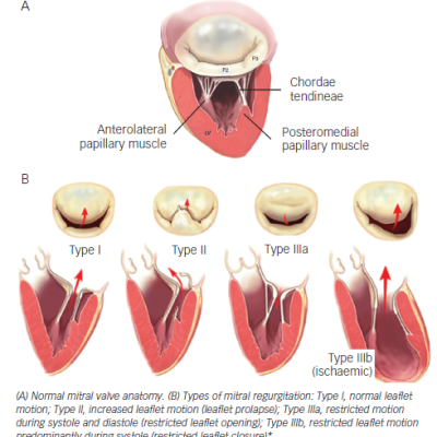 Figure 1 Carpentier´s Classification of Mitral Regurgitation