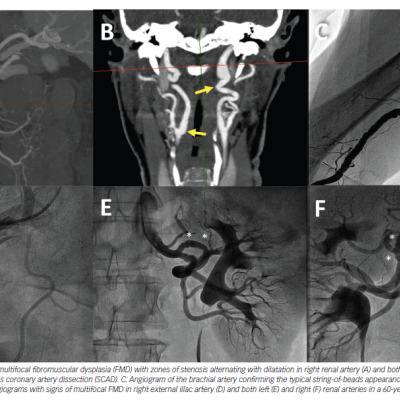 Figure 1 Fibromuscular Dysplasia in Spontaneous Coronary Artery Dissection