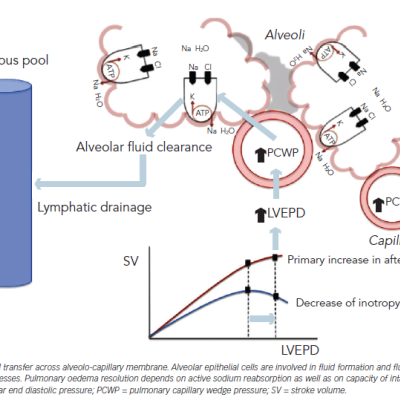 Figure 1 Illustration of Pressure-dependent- and Pressure-independent Mechanisms Responsible for Pulmonary Oedema Formation and Resolution