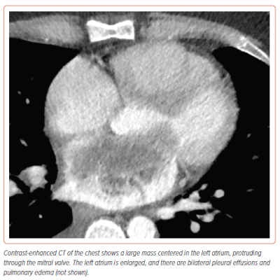 Figure 1 Initial CT Imaging of the Mass