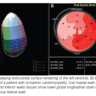 Figure 1 Novel Techniques in Echocardiography Applied on Heart Failure Patients