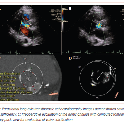 Figure 1 Preoperative Evaluation of the Aortic Valve