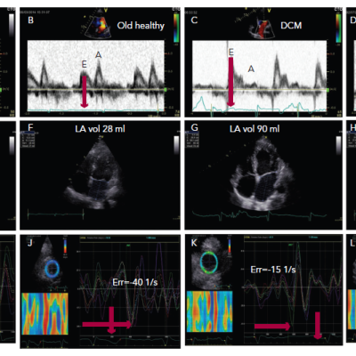 Figure 1 Three Diastolic Phases are Shown Early Diastole Diastasis and Late Diastole Atrial Systole