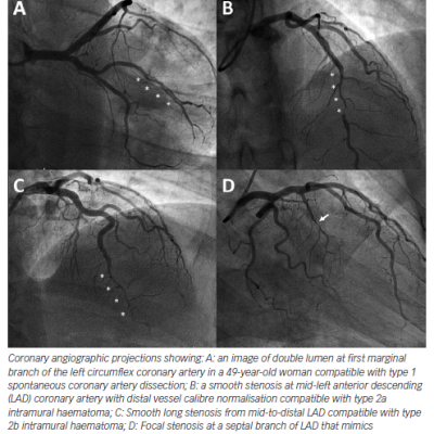 Figure 2 Angiographic Patterns in Spontaneous Coronary Artery Dissection