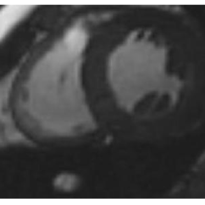 Figure 2 T2 Image From a Patient with Iron Deposition Due to Haemochromatosis