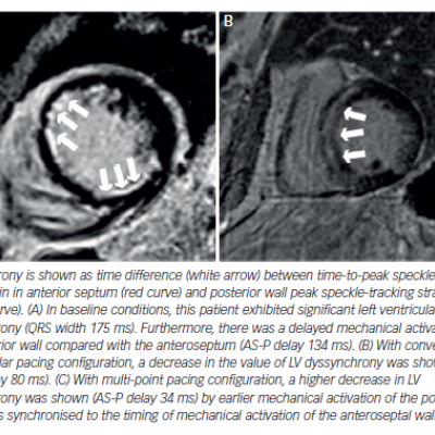 Figure 3 Examples of Late Gadolinium Enhancement Patterns Arrows 