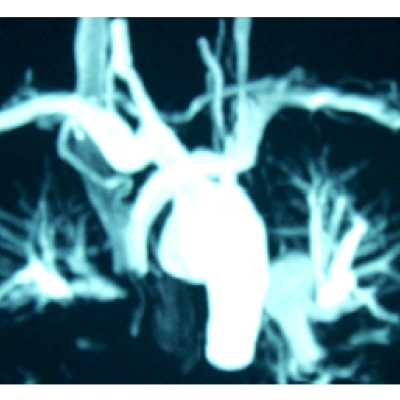 Figure 3 Magnetic Resonance Angiography Shows Subclavian Stenosis in a Patient with Takayasu Disease