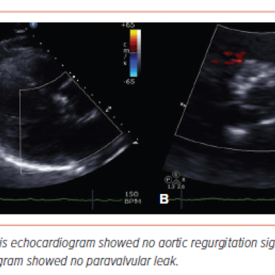 Figure 3 Postoperative Transthoracic Echocardiography Imaging of the Aortic Valve