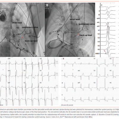 Figure 4 A 16-year-old Patient with Atrial Switch Repair and Post-surgical Complete Atrioventricular Block