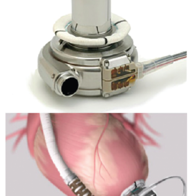 Figure 4 HeartWare Ventricular Assist Device