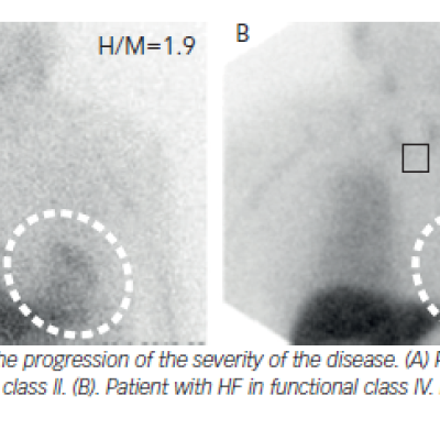 Figure 4 Iodine-123-metaiodobenzylguanidine Imaging in Heart Failure