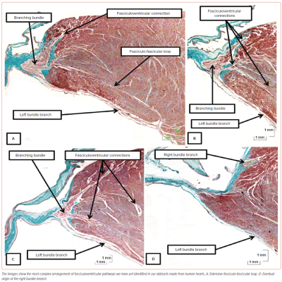 Figure 5 Histological Arrangement of Fasciculoventricular Pathways