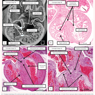 Figure 6 Embryological Formation of the Ventricular Components of the Conduction Axis