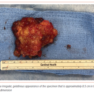 Figure 6 Gross Surgical Specimen