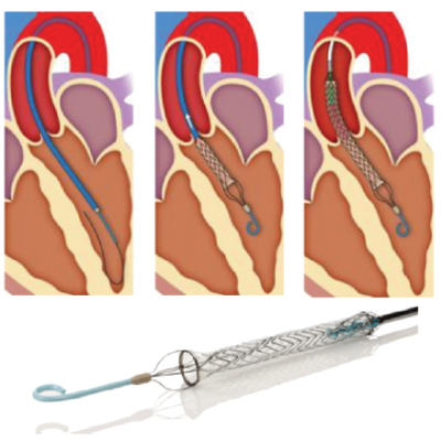 Figure 7 Thoratec® Percutaneous Heart Pump