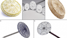 Patent Foramen Ovale (PFO) Closure: Procedure & Indications