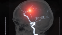 Cardiologists and Stroke Thrombectomy | ICR Journal