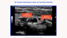 Internal Carotid Artery Chronic Occlusion: B-mode and Colour Doppler ...