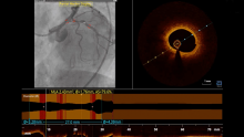 Coronary Intravascular Lithotripsy In The Presence Of Left Main ...