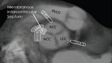 Permanent Pacemaker Implantation after TAVR