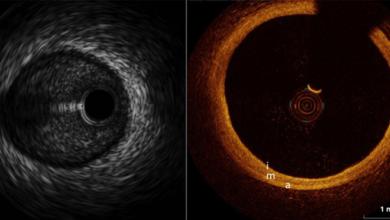 Intracoronary Imaging: When to use IVUS and OCT