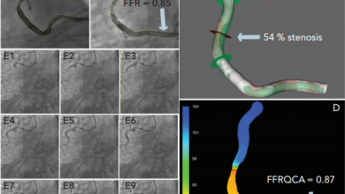 Fractional Flow Reserve Derived from Coronary Imaging and Computational Fluid Dynamics