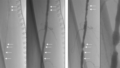 Restenosis After Tack Implantation is Associated