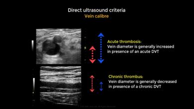 Acute and chronic Deep vein thrombosis. Vein diameter variation