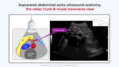 Celiac Trunk ultrasound appearance- vascular ultrasound learning