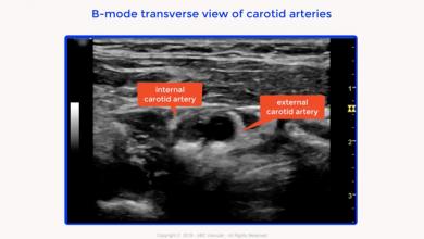 Internal carotid artery chronic occlusion: B-mode and colour Doppler flow appearance.Carotid Doppler