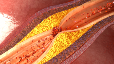 Coronary Artery Disease and Myocardial Infarction