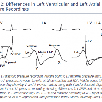 Figure 2 Differences in Left Ventricular and Left Atrial Pressure Recordings