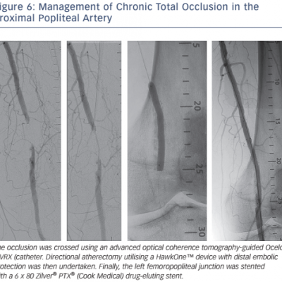 Figure 6: Management of Chronic Total Occlusion in the Proximal Popliteal Artery