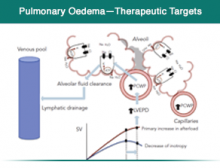 pulmonary edema signs and symptoms