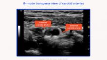 Internal Carotid Artery Chronic Occlusion: B-mode And Colour Doppler 